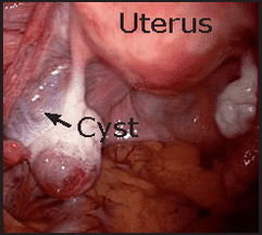 ovarian cysts cyst normal problem pathophysiology